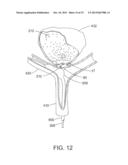 OVER-THE-WIRE EXCLUSION DEVICE AND SYSTEM FOR DELIVERY diagram and image