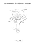 OVER-THE-WIRE EXCLUSION DEVICE AND SYSTEM FOR DELIVERY diagram and image