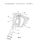 Devices and Methods for Dilating a Paranasal Sinus Opening and for     Treating Sinusitis diagram and image