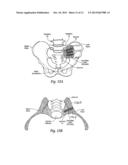 TISSUE DILATOR AND PROTECTOR diagram and image