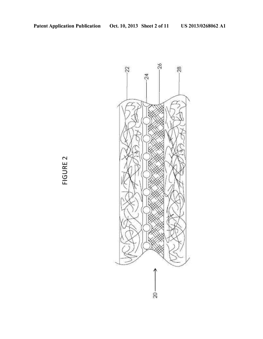 COMPOSITE PROSTHETIC DEVICES - diagram, schematic, and image 03