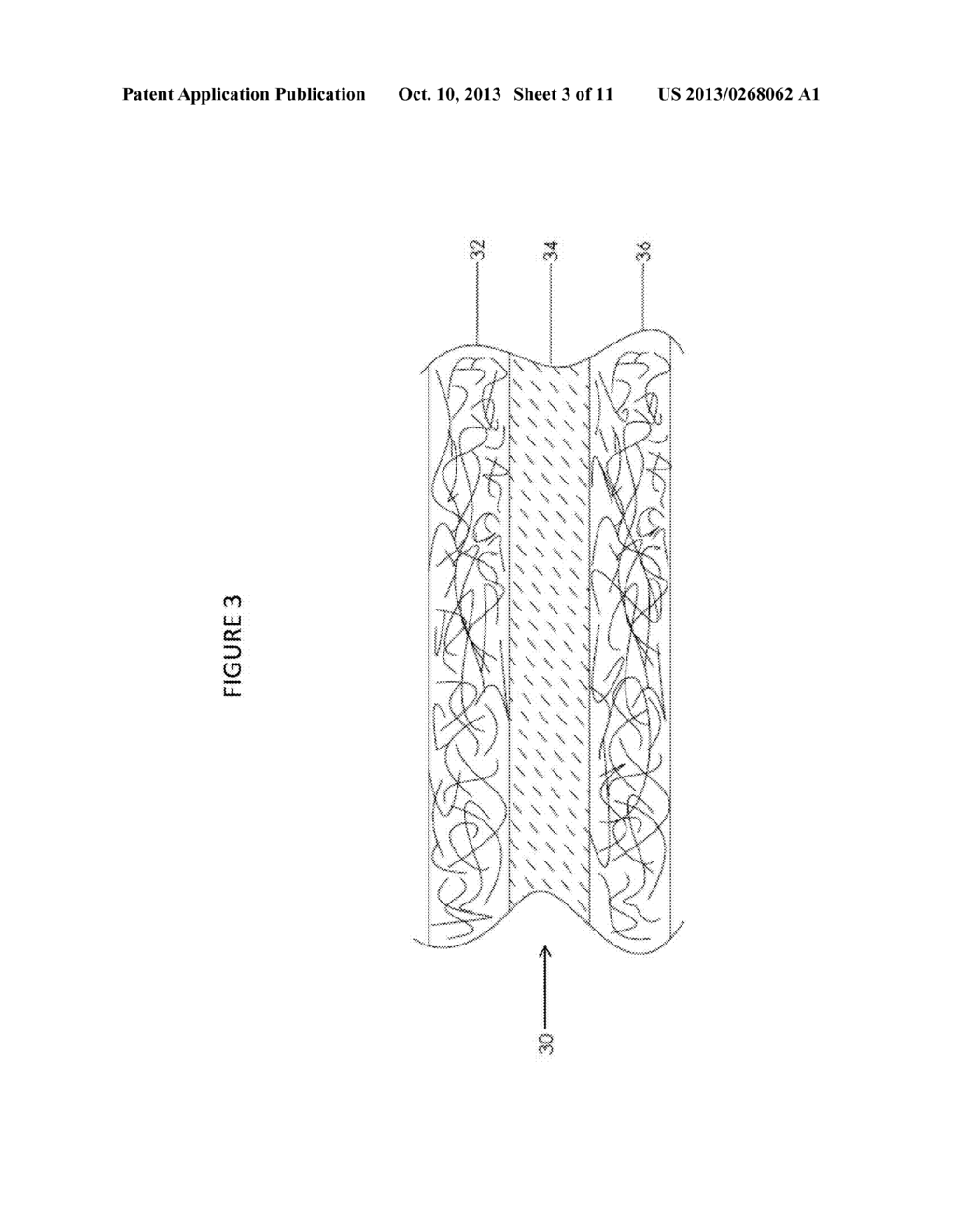 COMPOSITE PROSTHETIC DEVICES - diagram, schematic, and image 04