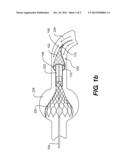 Heart Valve Prosthesis Recapture Devices diagram and image