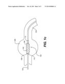 Heart Valve Prosthesis Recapture Devices diagram and image