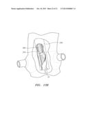 PROSTHETIC HEART VALVES, SCAFFOLDING STRUCTURES, AND SYSTEMS AND METHODS     FOR IMPLANTING OF SAME diagram and image