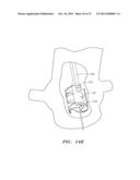 PROSTHETIC HEART VALVES, SCAFFOLDING STRUCTURES, AND SYSTEMS AND METHODS     FOR IMPLANTING OF SAME diagram and image