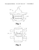 INTERBODY SPINAL IMPLANTS WITH EXTRAVERTEBRAL SUPPORT PLATES diagram and image