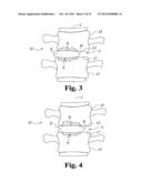 INTERBODY SPINAL IMPLANTS WITH EXTRAVERTEBRAL SUPPORT PLATES diagram and image