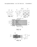 Atraumatic Stent and Method and Apparatus for making the same diagram and image