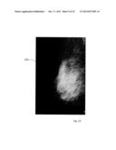 High Dynamic Range Mammography Using a Restricted Dynamic Range Full Field     Digital Mammogram diagram and image