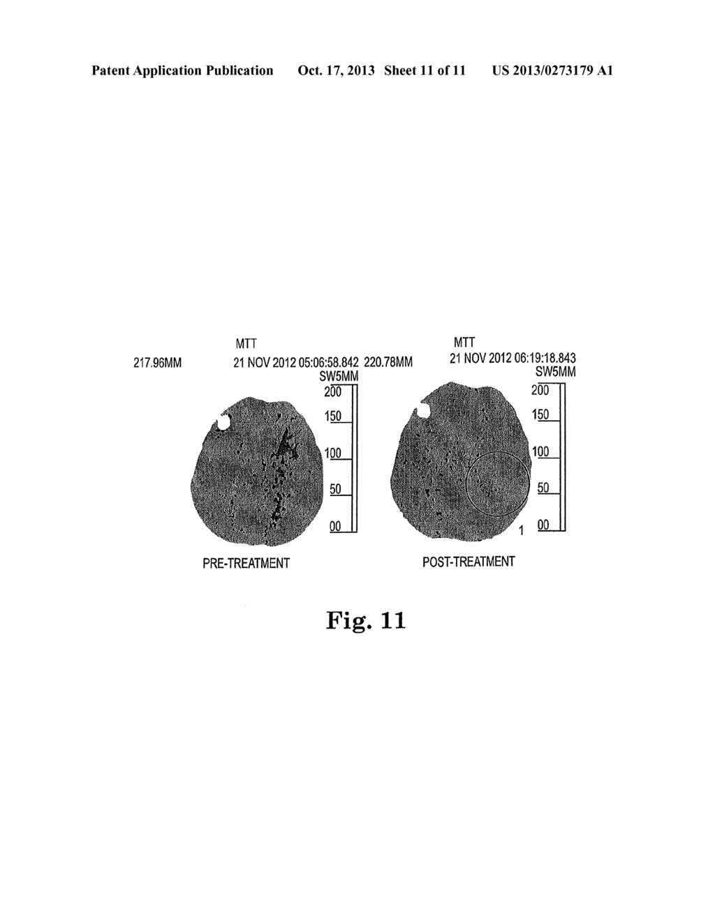 SYSTEM AND METHOD FOR IMPROVING OUTCOME OF CEREBRAL ISCHEMIA - diagram, schematic, and image 12