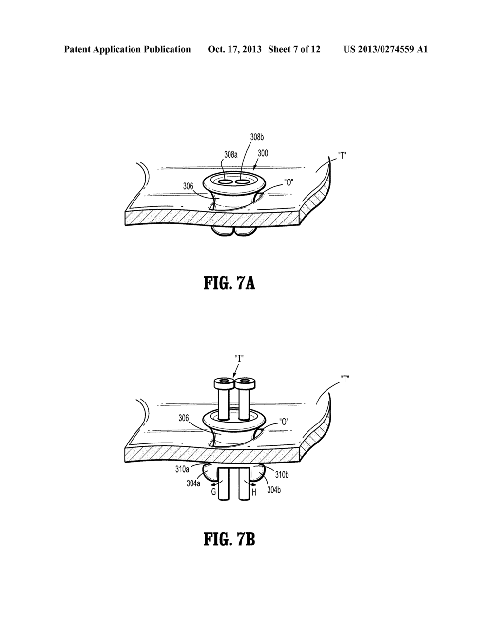 Foam Introduction System Including Modified Port Geometry - diagram, schematic, and image 08