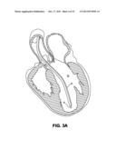 DEVICES AND METHODS FOR DELIVERING AN ENDOCARDIAL DEVICE diagram and image