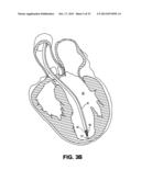 DEVICES AND METHODS FOR DELIVERING AN ENDOCARDIAL DEVICE diagram and image