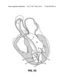 DEVICES AND METHODS FOR DELIVERING AN ENDOCARDIAL DEVICE diagram and image