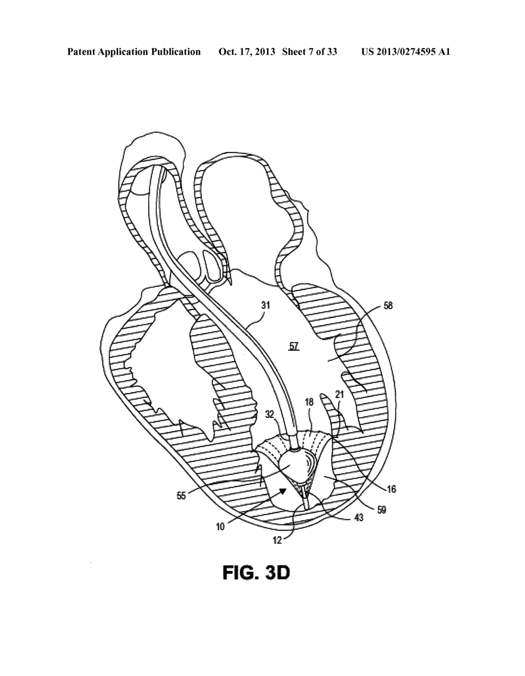DEVICES AND METHODS FOR DELIVERING AN ENDOCARDIAL DEVICE - diagram, schematic, and image 08