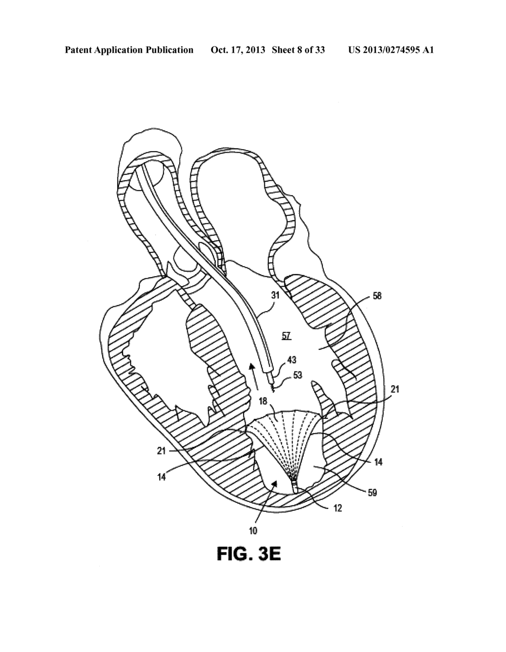 DEVICES AND METHODS FOR DELIVERING AN ENDOCARDIAL DEVICE - diagram, schematic, and image 09