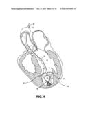 DEVICES AND METHODS FOR DELIVERING AN ENDOCARDIAL DEVICE diagram and image