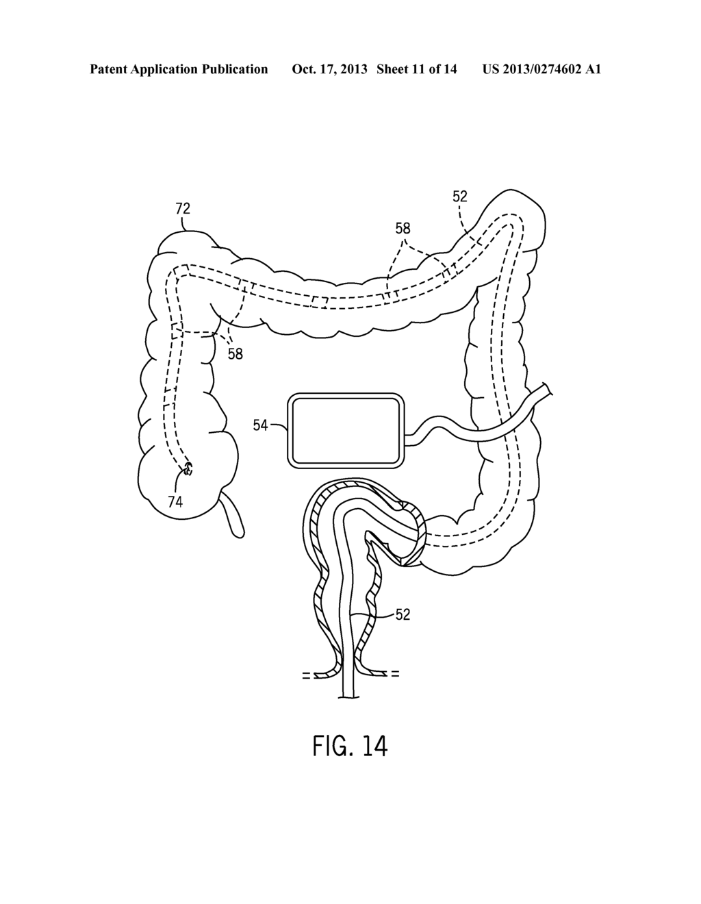 COLONOSCOPY SYSTEMS AND METHODS - diagram, schematic, and image 12