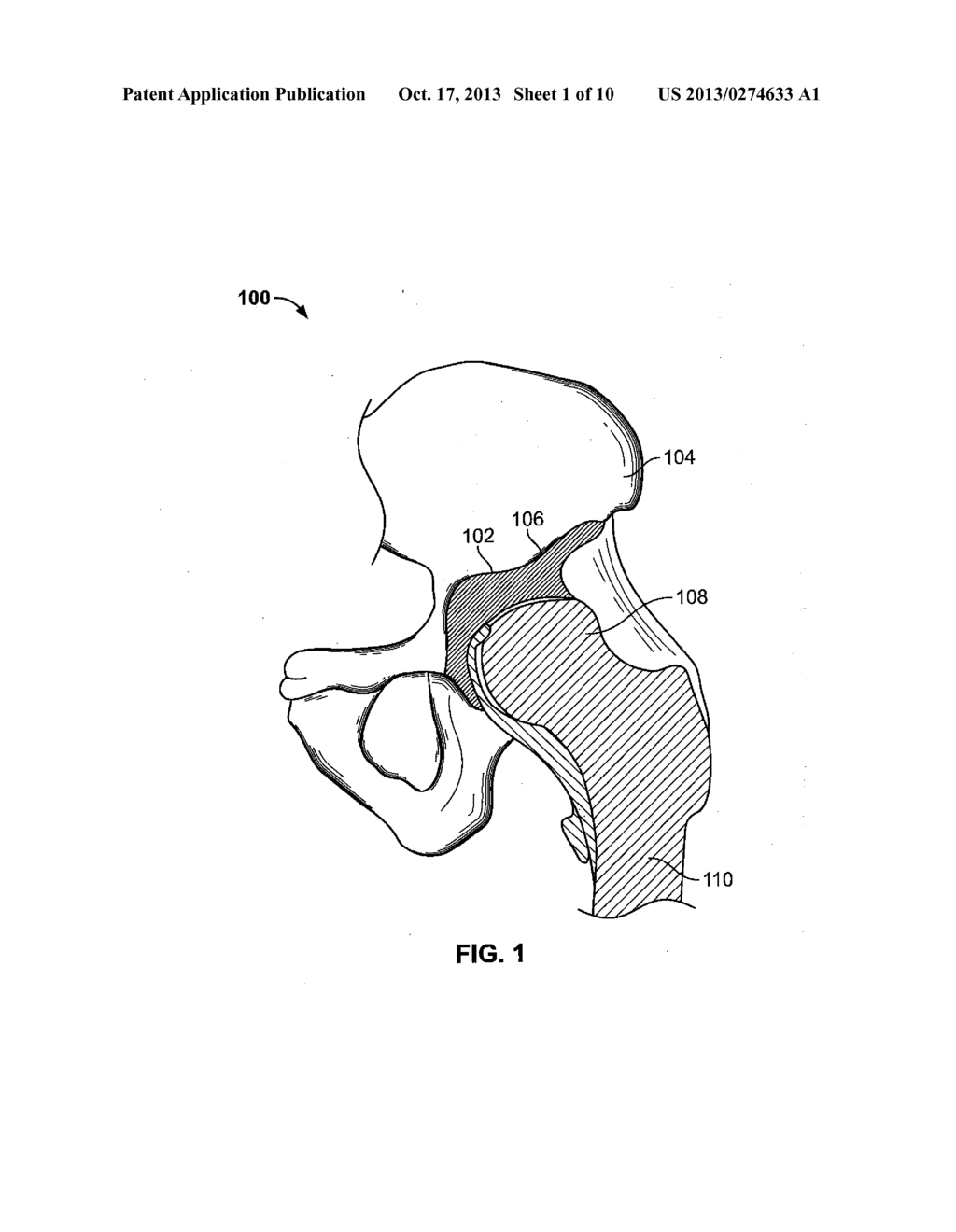 Computer-Assisted Joint Replacement Surgery and Navigation Systems - diagram, schematic, and image 02