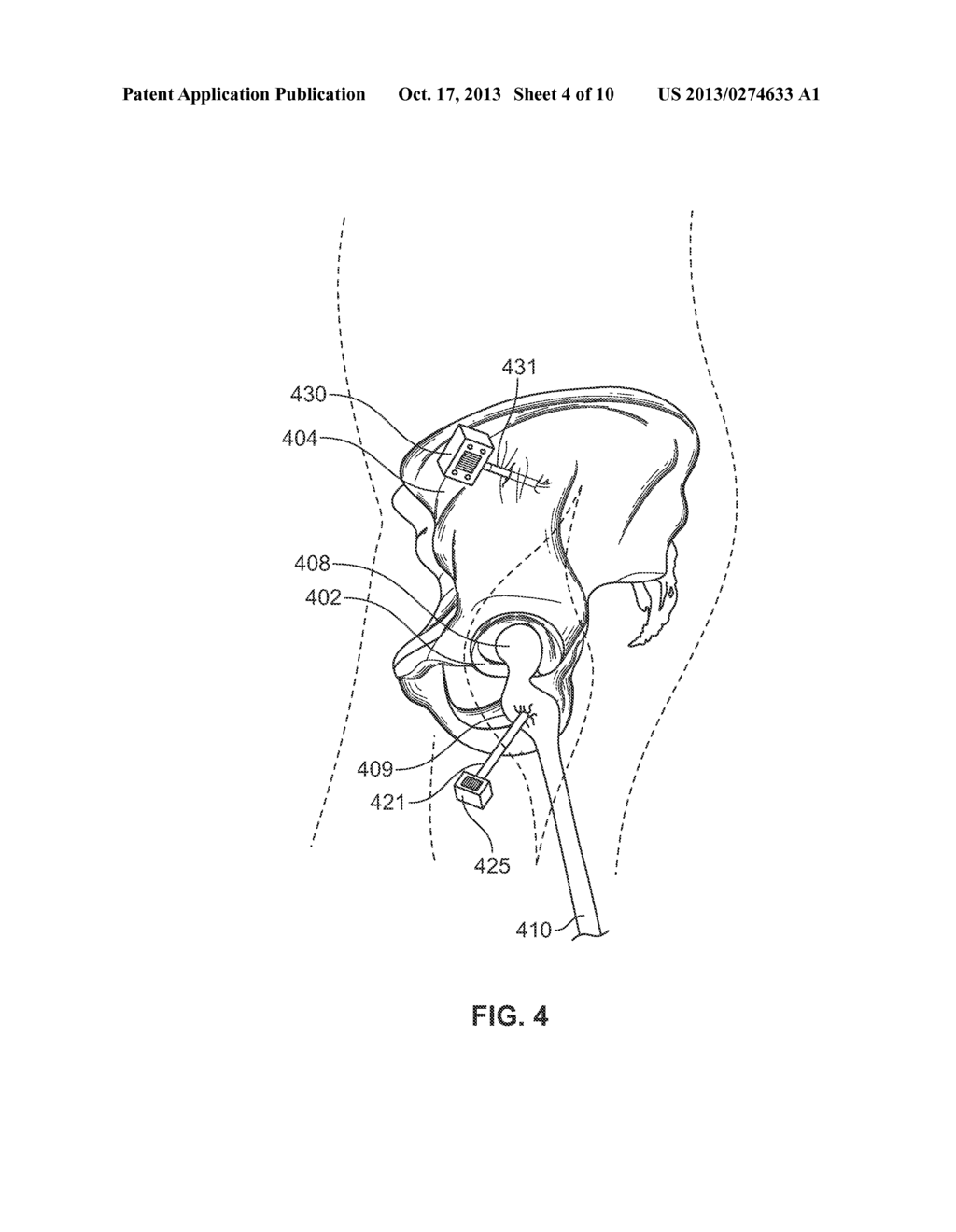 Computer-Assisted Joint Replacement Surgery and Navigation Systems - diagram, schematic, and image 05