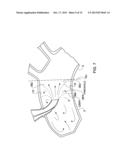 ARTERIAL DEVICE, SYSTEM AND METHOD FOR REMOVING EMBOLIC DEBRIS diagram and image