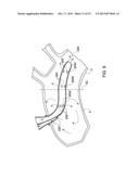 ARTERIAL DEVICE, SYSTEM AND METHOD FOR REMOVING EMBOLIC DEBRIS diagram and image