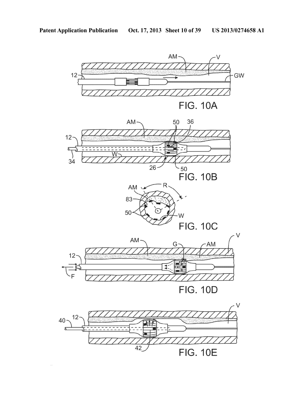 SELECTABLE ECCENTRIC REMODELING AND/OR ABLATION - diagram, schematic, and image 11