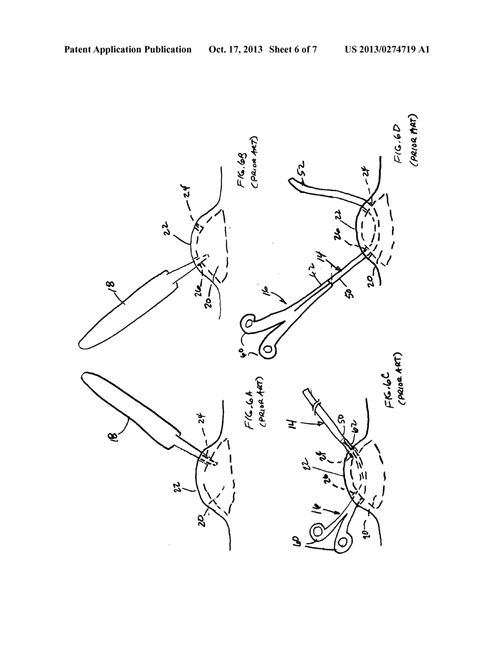 CUTANEOUS ABSCESS DRAINAGE DEVICE AND METHODS - diagram, schematic, and image 07