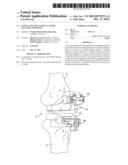 Patient Specific Surgical Guide Locator and Mount diagram and image