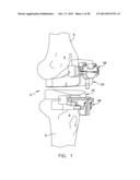 Patient Specific Surgical Guide Locator and Mount diagram and image