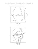 Patient Specific Surgical Guide Locator and Mount diagram and image