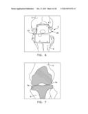 Patient Specific Surgical Guide Locator and Mount diagram and image