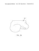 Patient Specific Surgical Guide Locator and Mount diagram and image