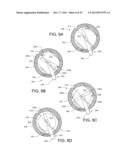 Anterior Capsulotomy Device and Procedure diagram and image