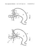 INVAGINATOR FOR GASTROESOPHAGEAL FLAP VALVE RESTORATION DEVICE diagram and image