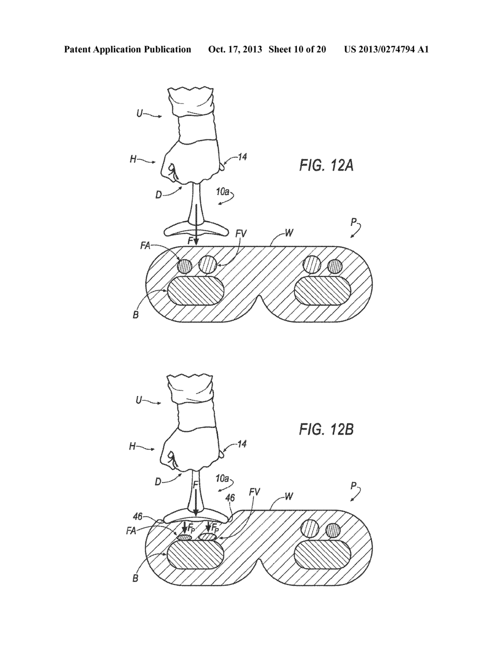 HEMOSTASIS DEVICE AND METHOD FOR USING THE SAME - diagram, schematic, and image 11