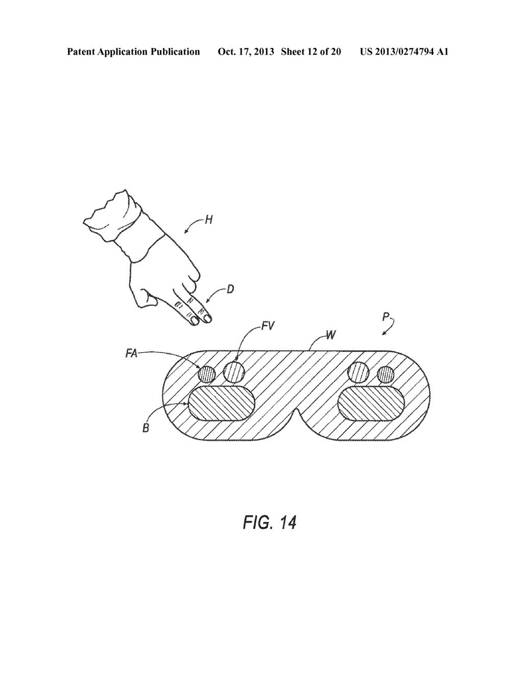 HEMOSTASIS DEVICE AND METHOD FOR USING THE SAME - diagram, schematic, and image 13