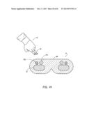 HEMOSTASIS DEVICE AND METHOD FOR USING THE SAME diagram and image