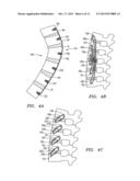 METHODS AND APPARATUS FOR STABILIZING A SPINAL SEGMENT diagram and image