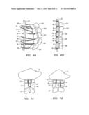 METHODS AND APPARATUS FOR STABILIZING A SPINAL SEGMENT diagram and image