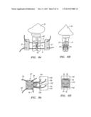 METHODS AND APPARATUS FOR STABILIZING A SPINAL SEGMENT diagram and image