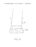 Transcatheter Stent-Valves and Methods, Systems and Devices for Addressing     Para-Valve Leakage diagram and image