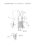 Transcatheter Stent-Valves and Methods, Systems and Devices for Addressing     Para-Valve Leakage diagram and image