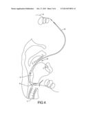 Catheter for Inserting A Voice Prosthesis diagram and image