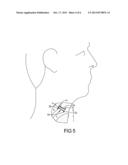 Catheter for Inserting A Voice Prosthesis diagram and image