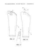 Toe Spacer Sock and Corrective Footwear diagram and image