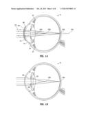 PUPIL DEPENDENT DIFFRACTIVE LENS FOR NEAR, INTERMEDIATE, AND FAR VISION diagram and image