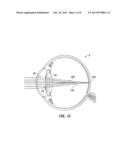 PUPIL DEPENDENT DIFFRACTIVE LENS FOR NEAR, INTERMEDIATE, AND FAR VISION diagram and image