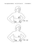 Flexible and/or Elastic Brachytherapy Seed or Sirand diagram and image